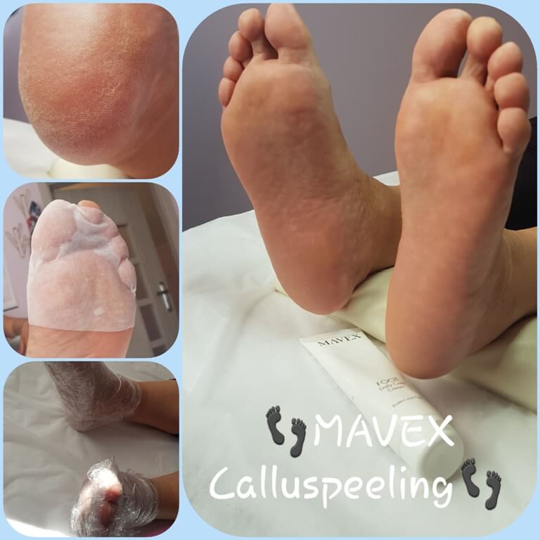 MAVEX Calluspeeling